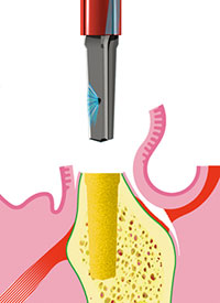 Implantatversorgung