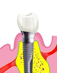 Implantatversorgung