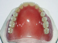 Totalprothese